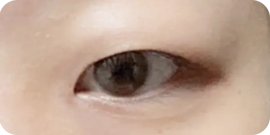 双眼皮手术前