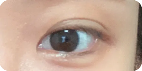 双眼皮手术前