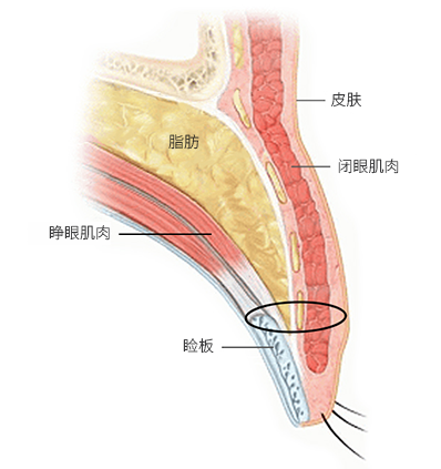 皮肤表面与隔膜之间粘连， 打造线条的手术
