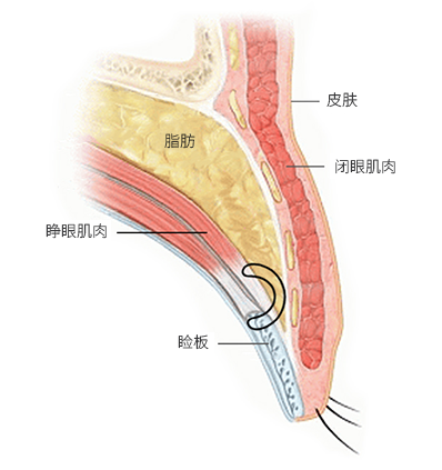 调整睁眼肌肉与强化睁眼力度的手术